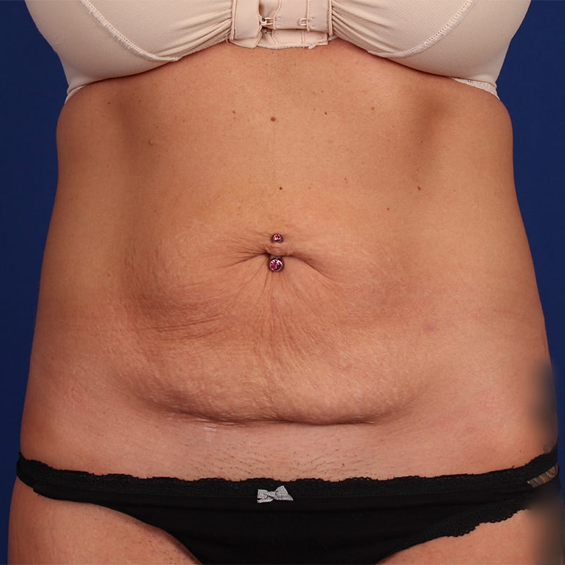 Abdominoplasty Before & After Image