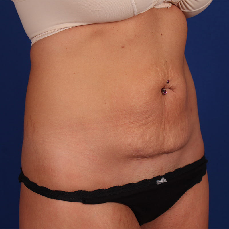 Abdominoplasty Before & After Image