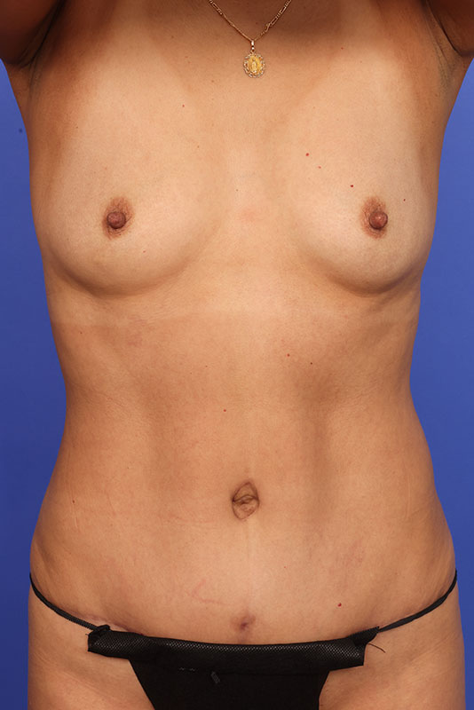 Abdominoplasty Before & After Image