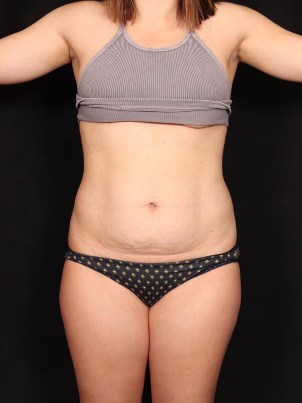 Abdominoplasty Before & After Image