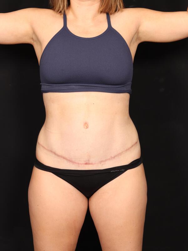 Abdominoplasty Before & After Image