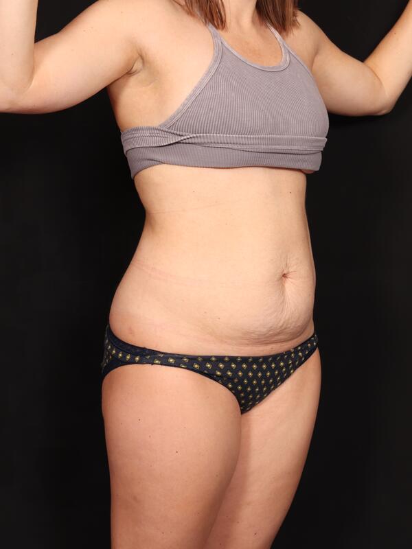 Abdominoplasty Before & After Image