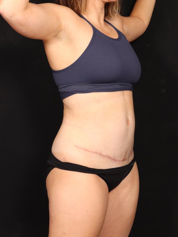 Abdominoplasty Before & After Image