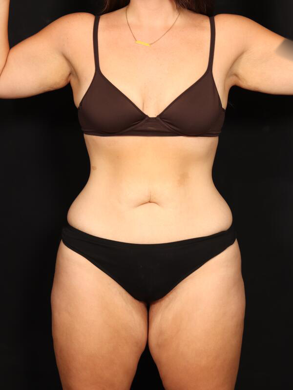 Abdominoplasty Before & After Image