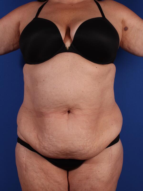 Abdominoplasty Before & After Image