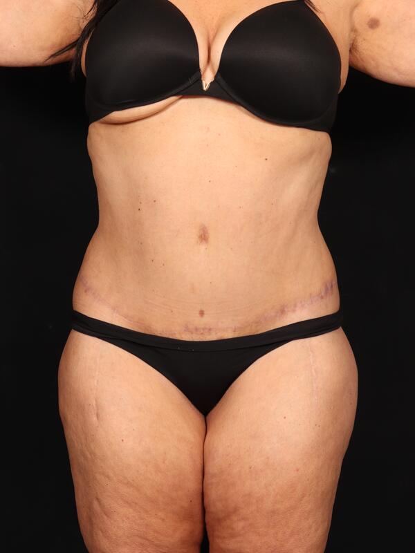 Abdominoplasty Before & After Image