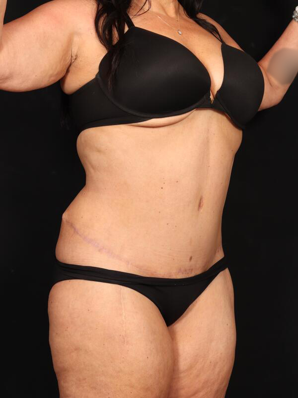 Abdominoplasty Before & After Image