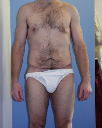 Body Contouring After Weight Loss Male Before & After Image
