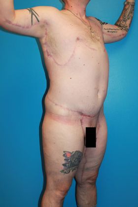 Body Contouring After Weight Loss Male Before & After Image