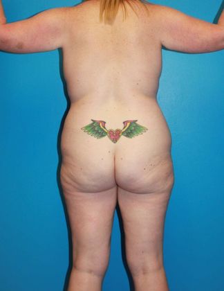 Flankplasty Before & After Image