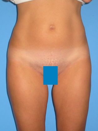 Liposuction Before & After Image