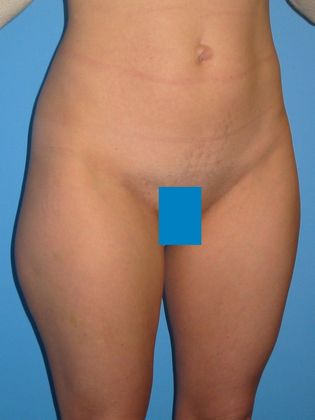 Liposuction Before & After Image