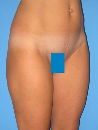 Liposuction Before & After Image