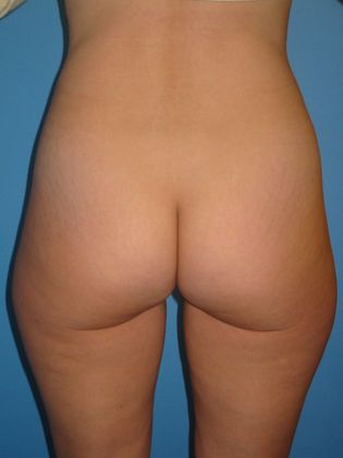 Liposuction Before & After Image