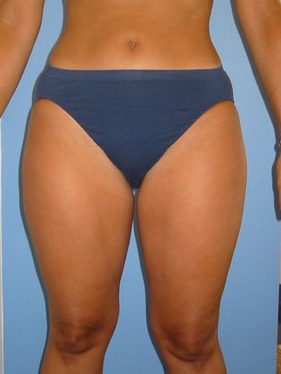 Liposuction Before & After Image