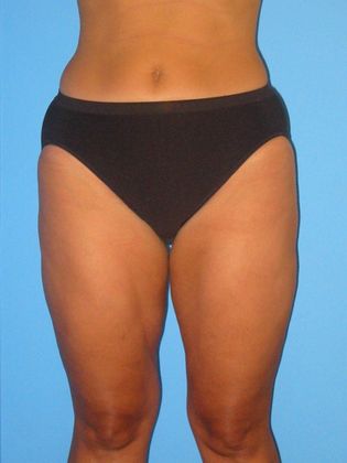 Liposuction Before & After Image