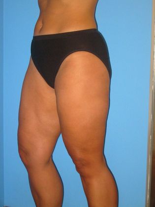 Liposuction Before & After Image