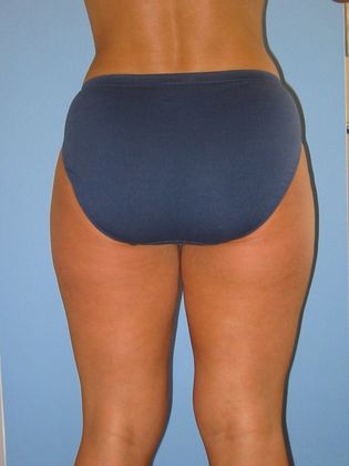 Liposuction Before & After Image