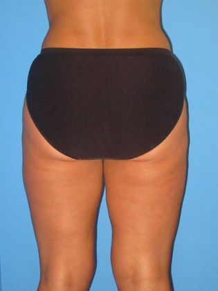 Liposuction Before & After Image