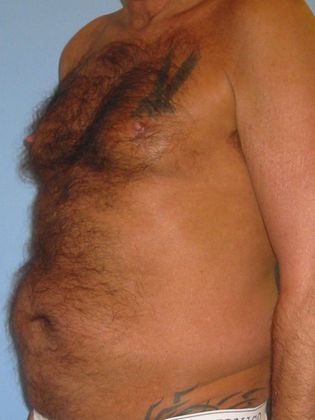 Liposuction Before & After Image