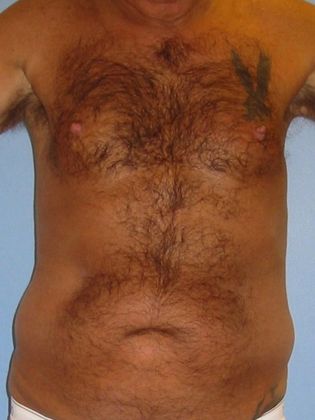 Liposuction Before & After Image