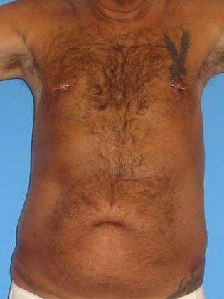 Liposuction Before & After Image