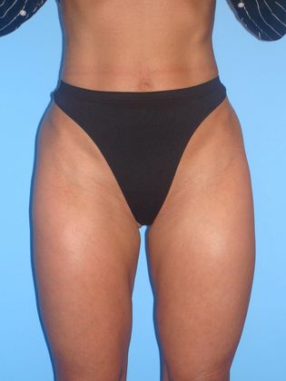 Liposuction Before & After Image