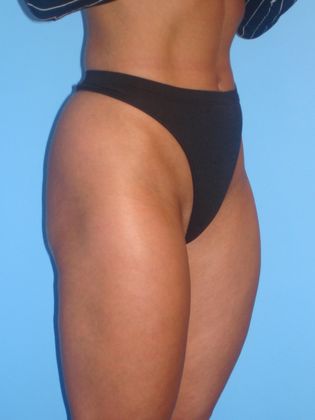 Liposuction Before & After Image