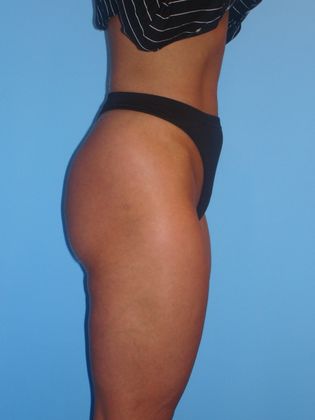 Liposuction Before & After Image