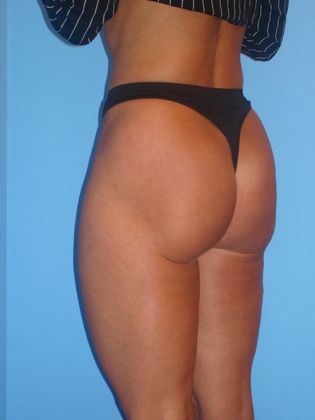 Liposuction Before & After Image