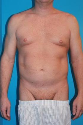 Liposuction Before & After Image