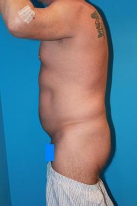 Liposuction Before & After Image