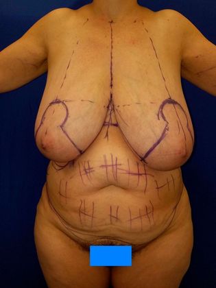 Liposuction Before & After Image