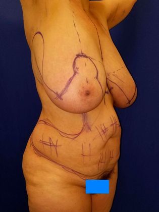 Liposuction Before & After Image