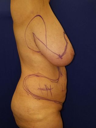 Liposuction Before & After Image