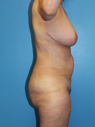 Liposuction Before & After Image