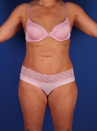 Liposuction Before & After Image