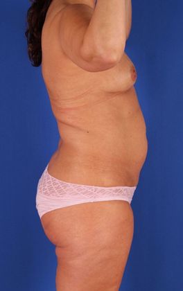 Liposuction Before & After Image