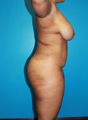 Liposuction Before & After Image