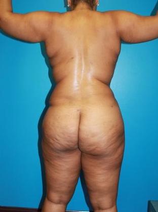 Liposuction Before & After Image