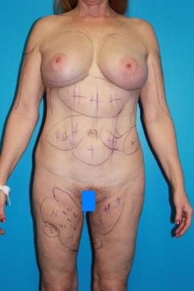 Liposuction Before & After Image