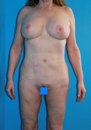 Liposuction Before & After Image