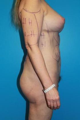 Liposuction Before & After Image