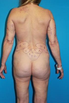 Liposuction Before & After Image