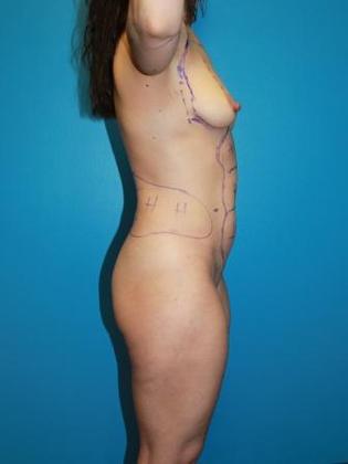 Liposuction Before & After Image