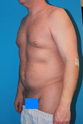 Liposuction Before & After Image