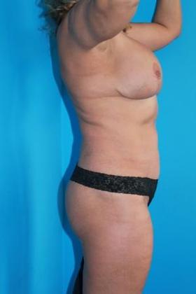 Liposuction Before & After Image