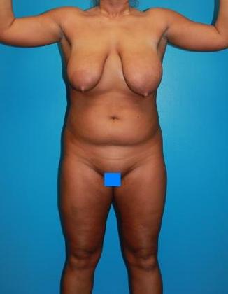 Liposuction Before & After Image