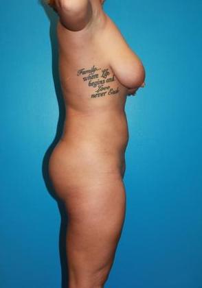 Liposuction Before & After Image