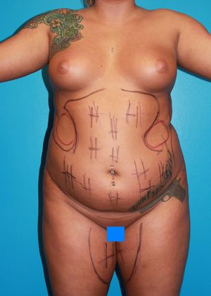 Liposuction Before & After Image